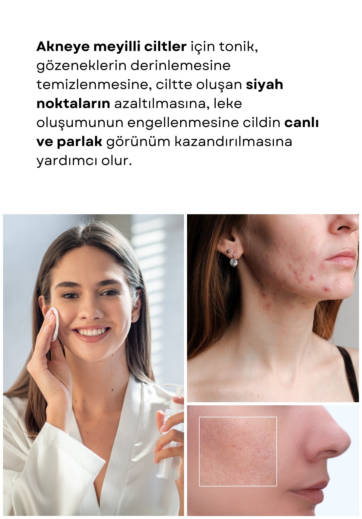 yüzünde sivilceler olan bir kadın